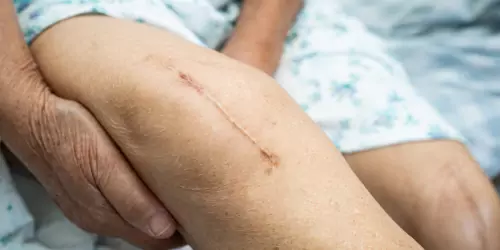 Here's how Restore Scar Therapy can help you
